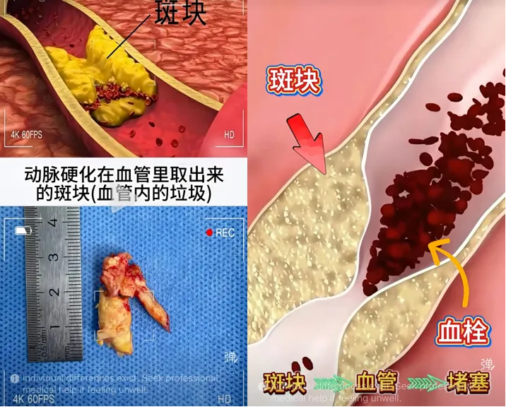 Blood Vessel Plaque and Blockage