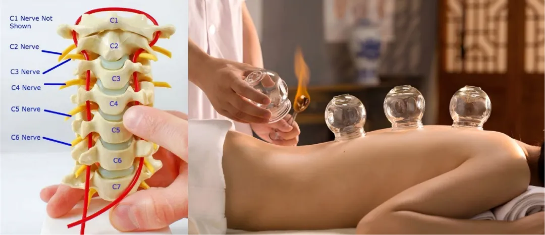 Cervical Nerves and Fire Cupping Therapy