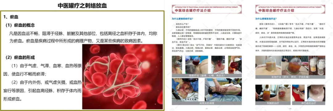 Cupping and Blood Stasis Concept